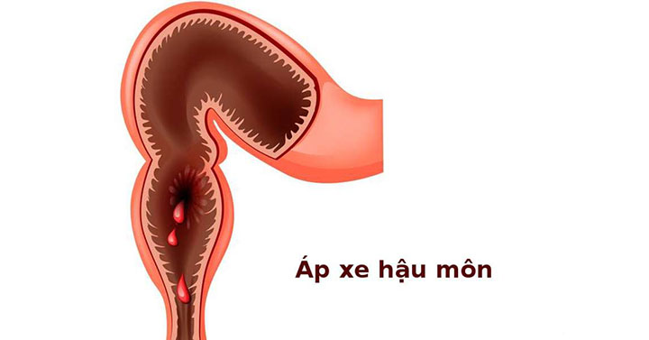 Bệnh áp xe hậu môn