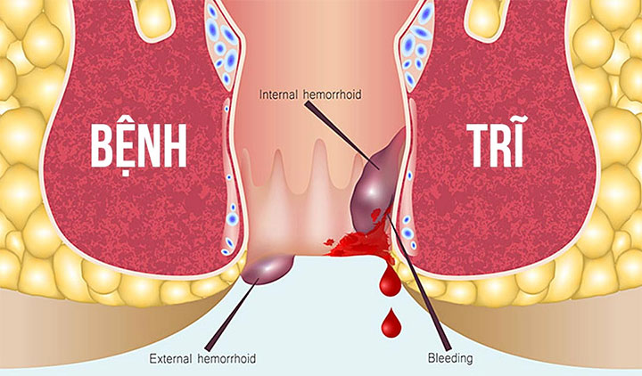 Bệnh trĩ gây ngứa rát hậu môn