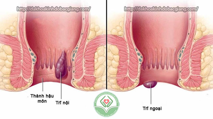 Bệnh trĩ