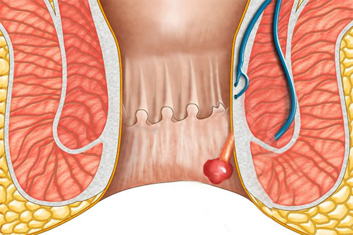 Polyp hậu môn