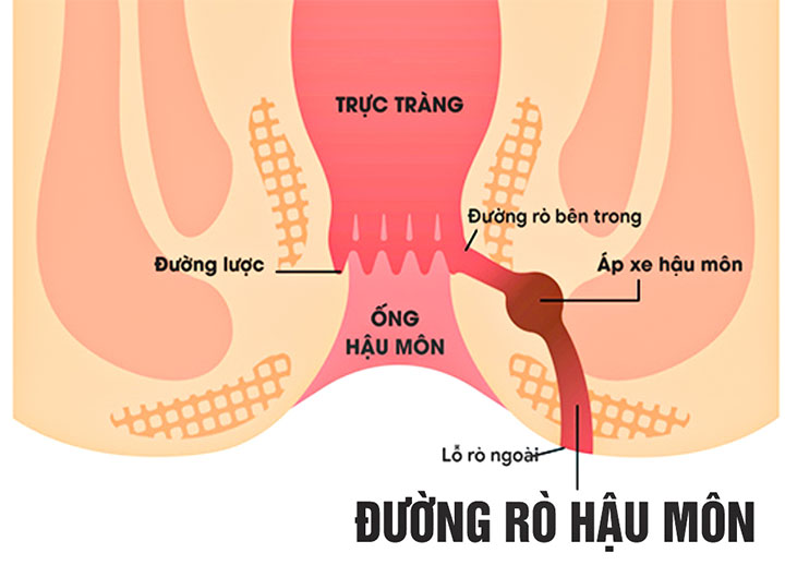 Rò hậu môn