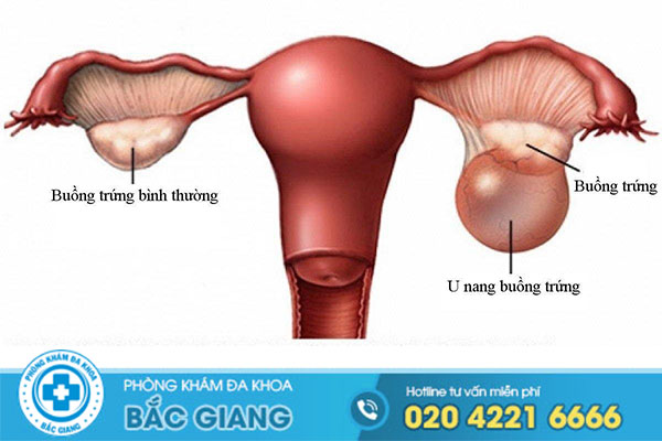 u-nang-buong-trung-la-gi-nguy-hiem-khong