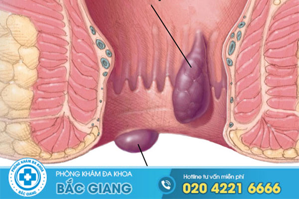 benh-tri-cach-dieu-tri-benh-tri-uy-tin