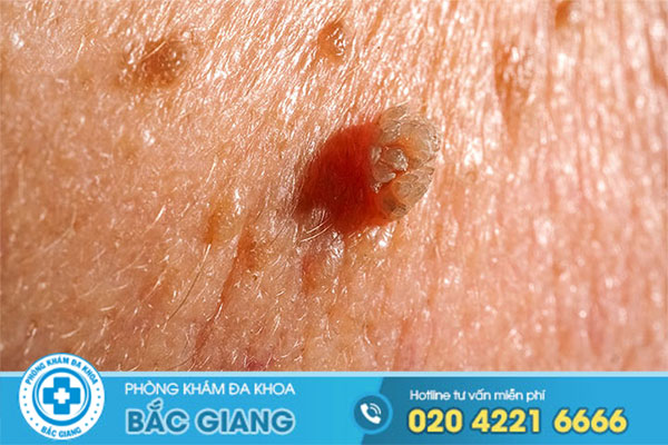 phuong-phap-dieu-tri-sui-mao-ga-tot-nhat