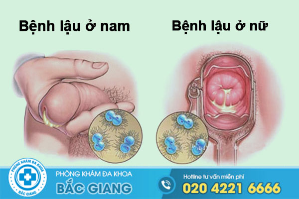 trieu-chung-benh-lau