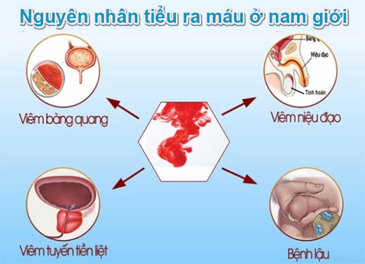 Tiểu ra máu