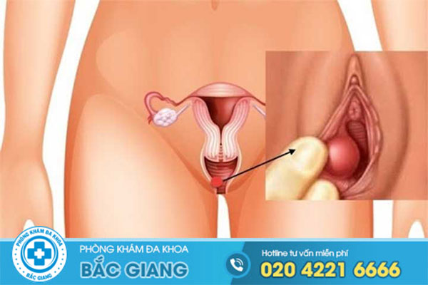 phuong-phap-giam-sung-vung-kin-cua-ban