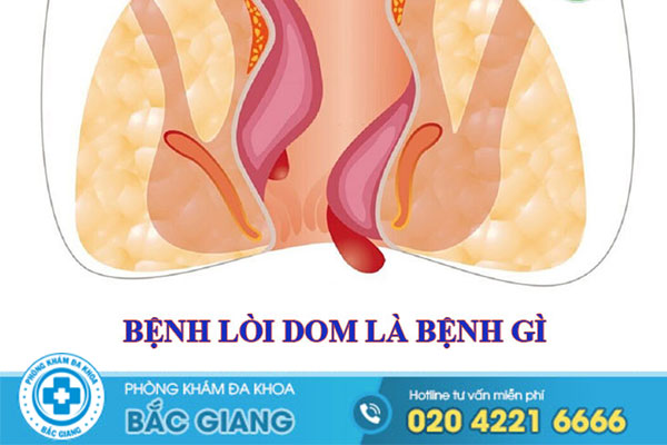 benh-loi-dom-la-benh-gi-dieu-tri-loi-dom